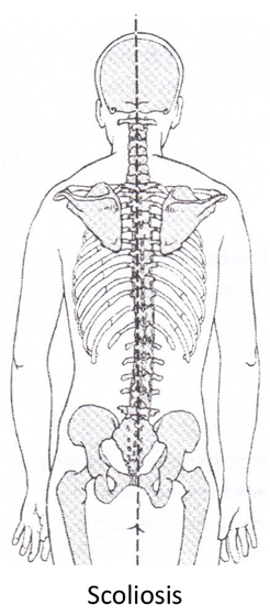 Scoliosis skeleton