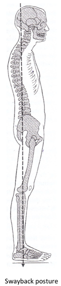 Swayback posture