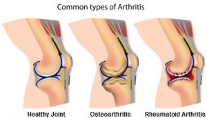 Different types of arthritis in the knee